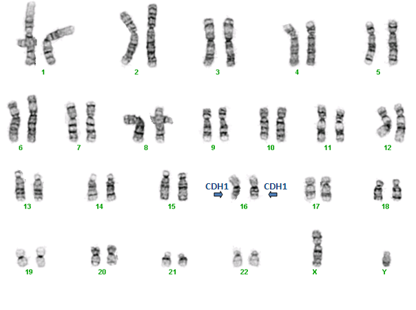 cdh1 mutation a