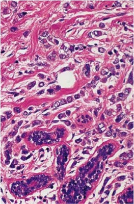 lobular breast cancer