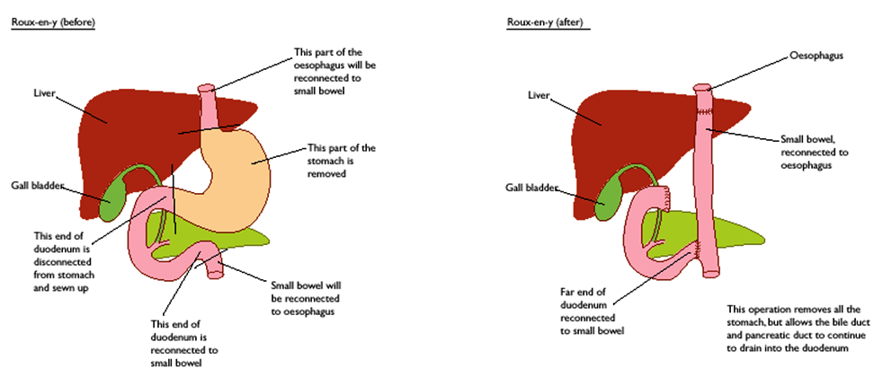 before and after images of gastrectomy