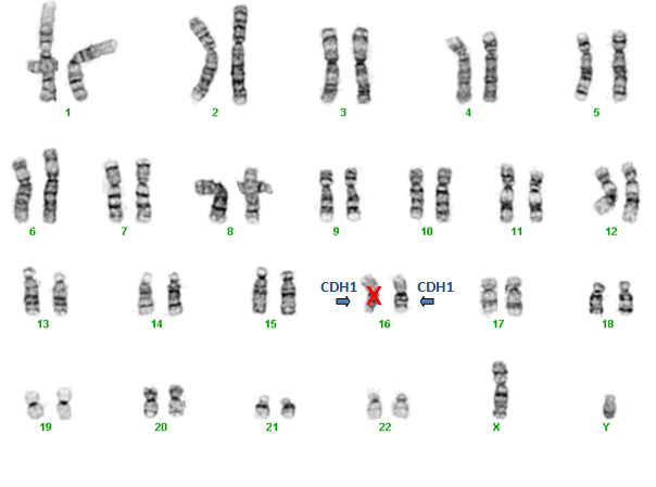 cdh1 mutation b